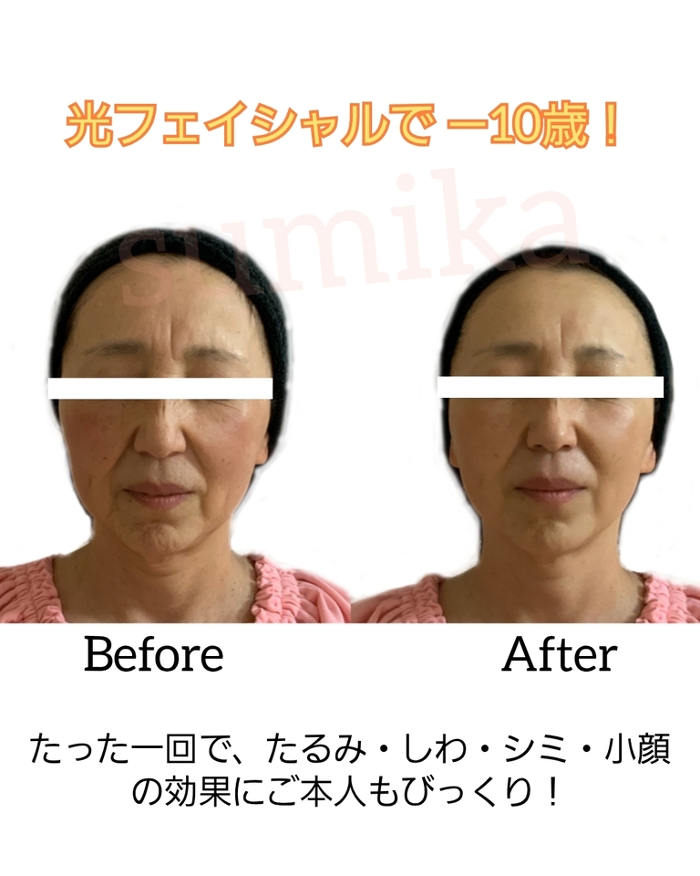 光フェイシャルで−10歳！！
