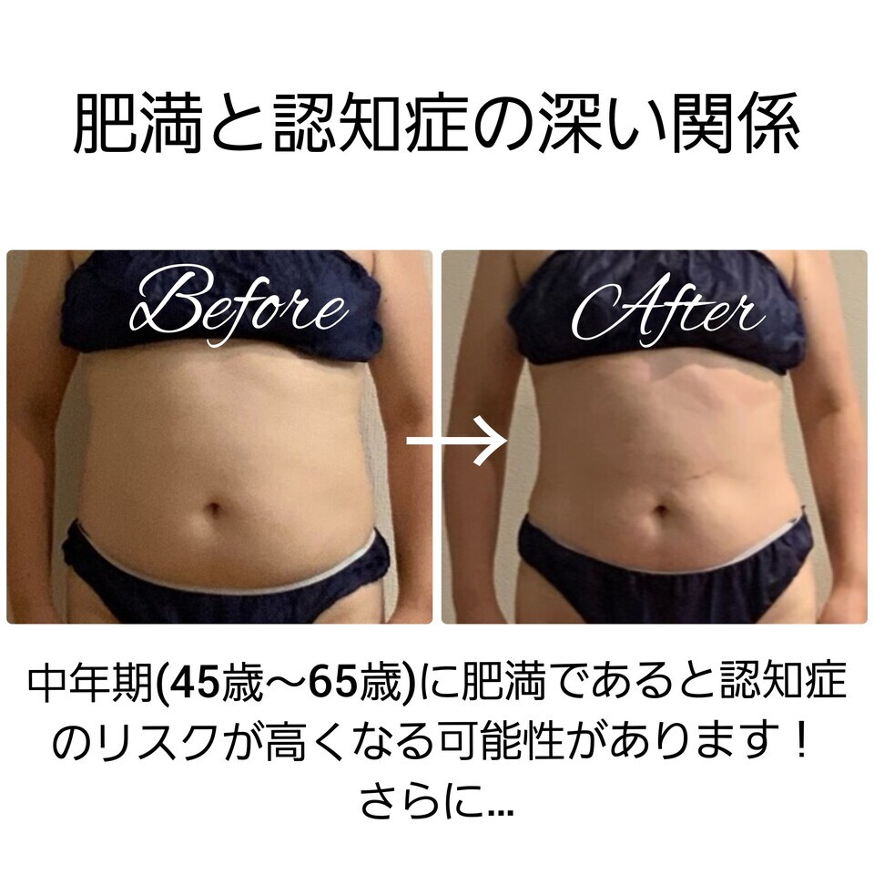 肥満と認知症の深い関係（＞＜）